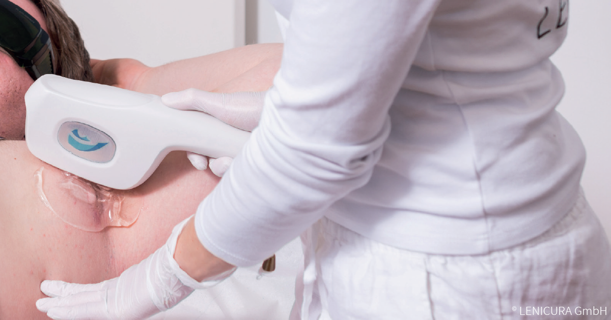 Abszess behandeln ohne OP mit der sanften lAight®-Therapie in der Akneambulanz.