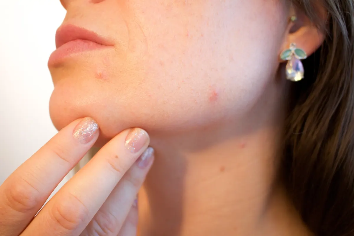 Therapiemöglichkeiten der Akne inversa / Hidradenitis suppurativa bei Ihrem Spezialisten der Akneambulanz.